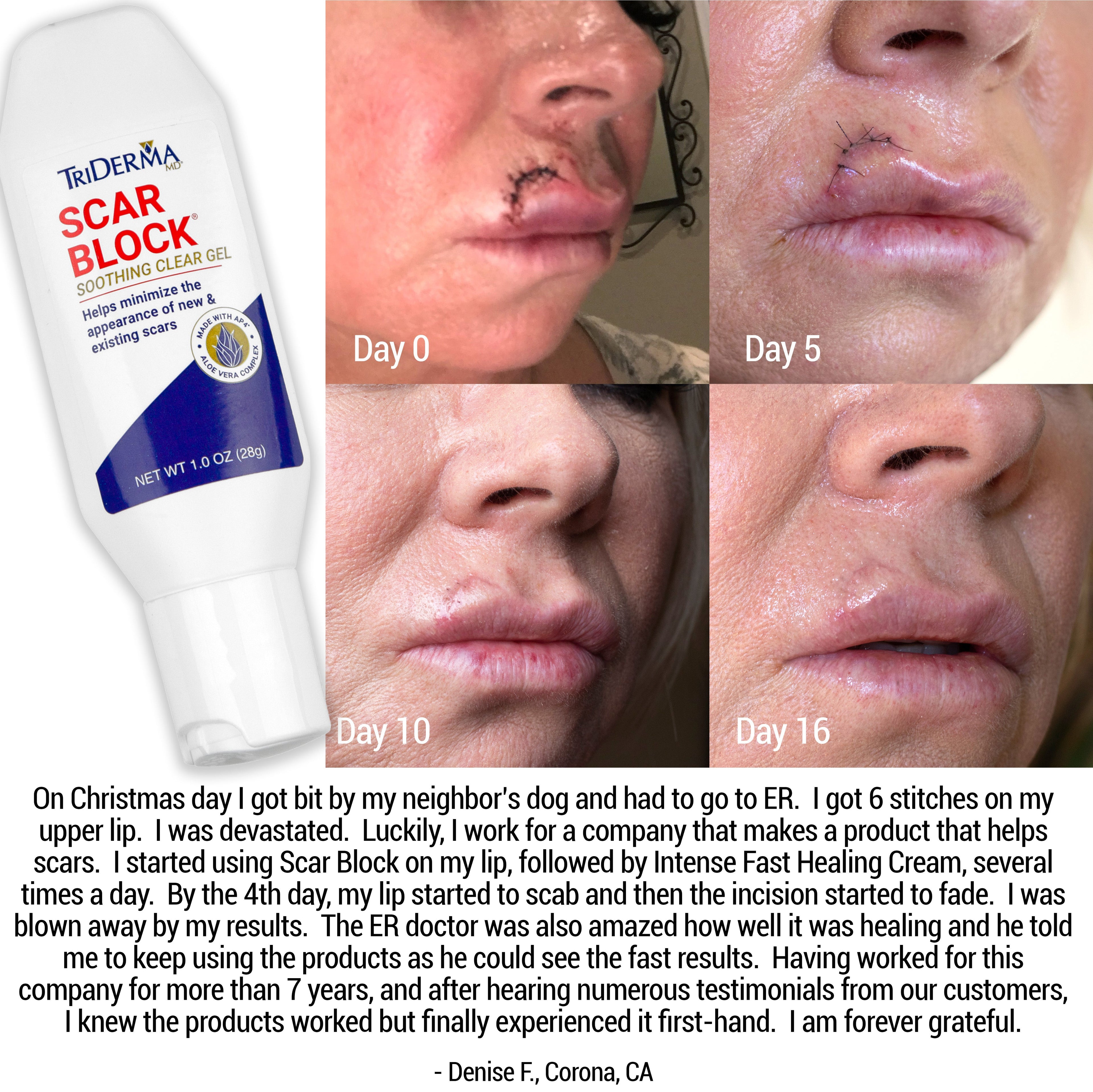 Scar Block Silicone Gel for New and Old Scars